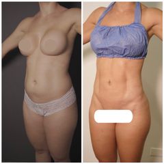 Lipoescultura - Dr Fulvio Alexander Correa