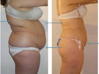 LIPOESCULTURA