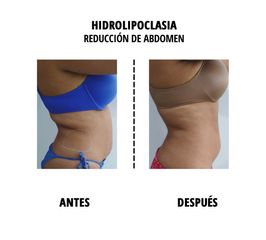 Hidrolipoclasia - Colorgy Medicina Estética y Spa