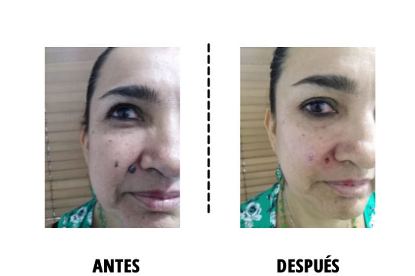 Lunares antes y después - 818997