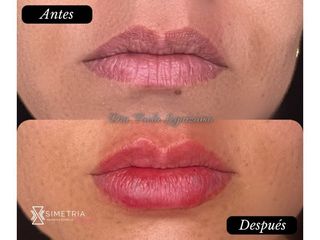 Aumento de labios - Simetría