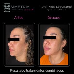 Rejuvenecimiento Facial - Dra. Paola Leguizamo