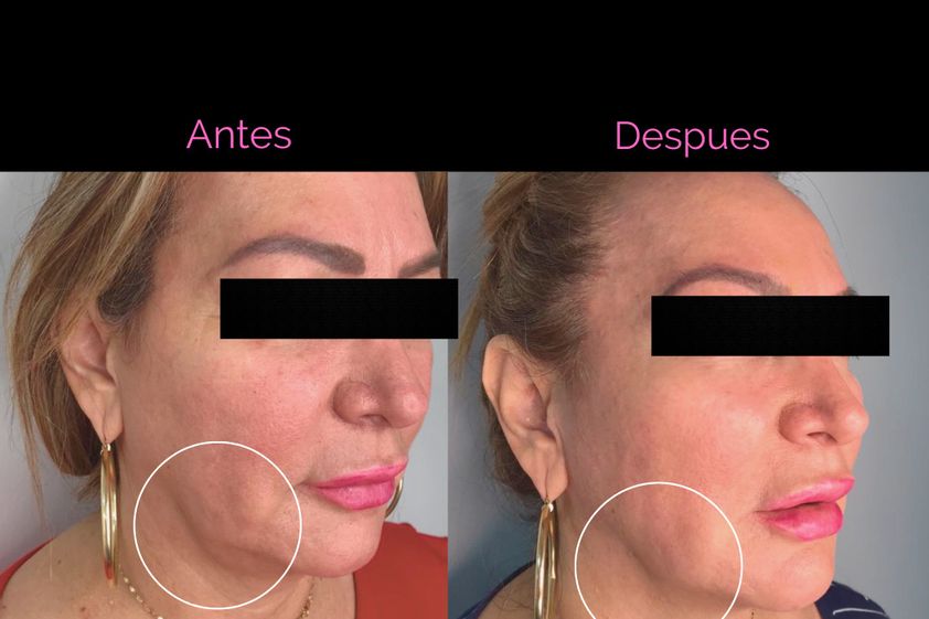 Hilos tensores antes y después - 852738