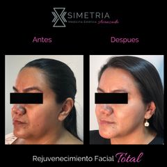 Rejuvenecimiento facial - Dra. Paola Leguizamo