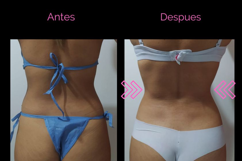 Tratamientos para adelgazar antes y después - 852741