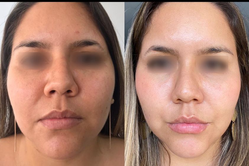 Rejuvenecimiento facial antes y después - 852742