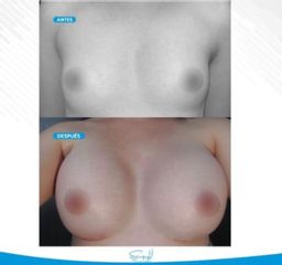 Mamoplastia de aumento - Dr. Christiam Suárez Giraldo