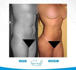 Liposucción - Dr. Christiam Suárez Giraldo