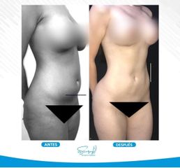Liposucción - Dr. Christiam Suárez Giraldo
