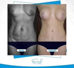 Abdominoplastia - Dr. Christiam Suárez Giraldo