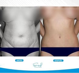 Abdominoplastia - Dr. Christiam Suárez Giraldo