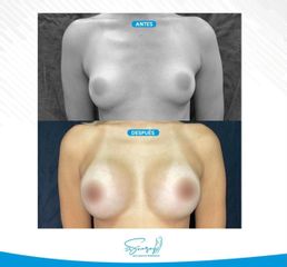 Mamoplastia de aumento - Dr. Christiam Suárez Giraldo