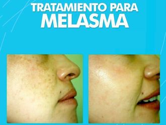 Manchas en la piel - 625456