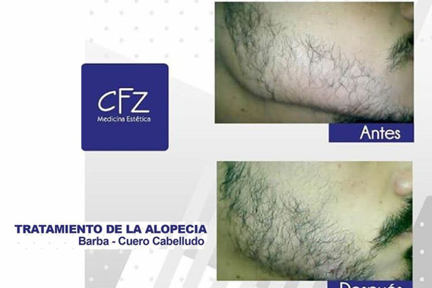 Alopecia antes y después - 625460