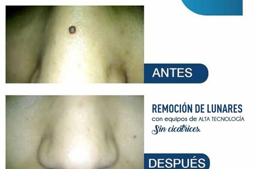Verrugas antes y después - 625464