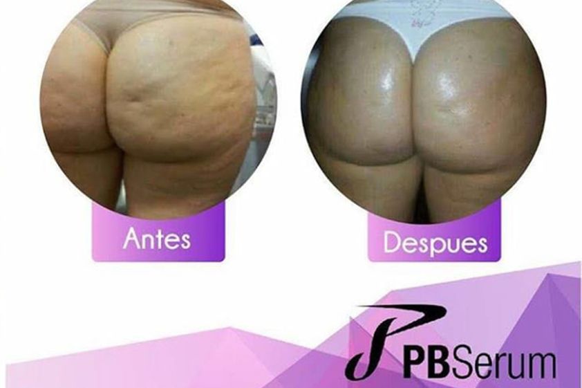 Celulitis antes y después - 625465