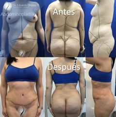 Abdominoplastia - Dr. Eduardo Orozco Díaz