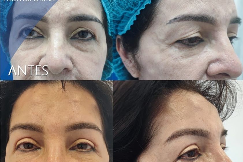 Lifting facial antes y después - 848274