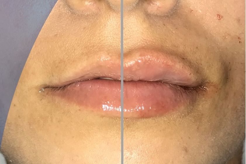 Aumento de labios antes y después - 848285