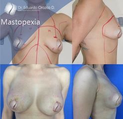 Mastopexia - Dr. Eduardo Orozco Díaz