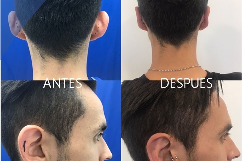 Otoplastia antes y después - 848290