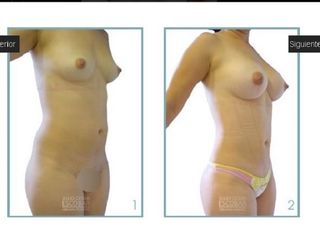 Mamoplastia de aumento