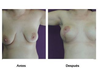 Levantamiento de senos
