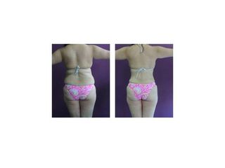 Abdominoplastía