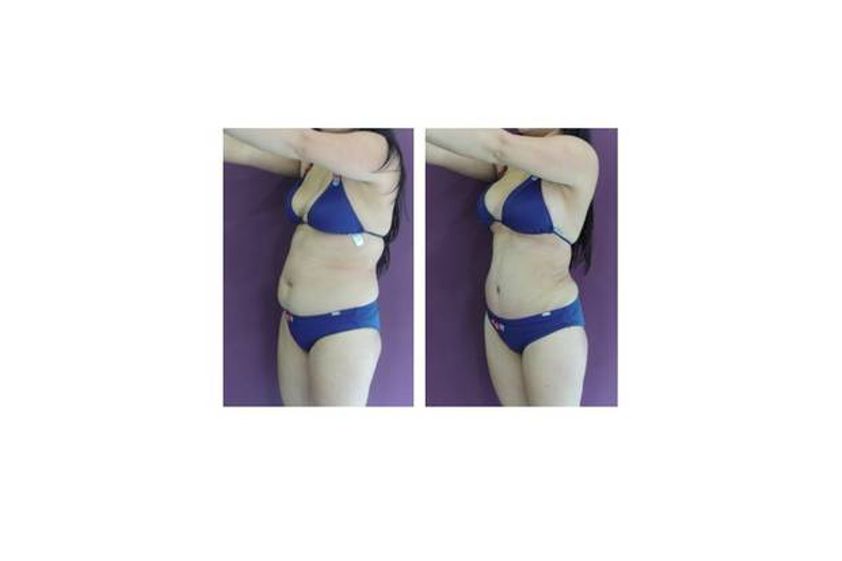 Liposucción antes y después - 529699