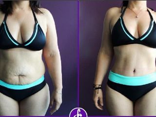 Antes y despues de abdominoplastia y lipoescultura