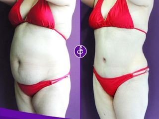 Antes y despues de abdominoplastia y lipoescultura