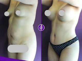 Antes y despues de exia mamaria, Abdominoplastia y Lipoescultura