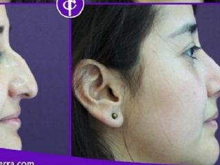 Antes y despues de rinoplastia