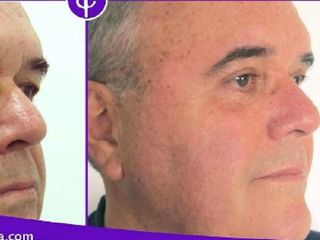 Antes y despues de blefaroplastia