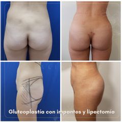Gluteoplastia - Dra. Natalia Reyes