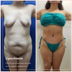 Lipectomia - Dra. Natalia Reyes