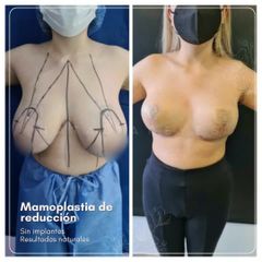 Mamoplastia de reducción - Dra. Natalia Reyes