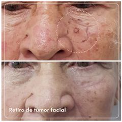 Eliminación tumor facial - Dra. Natalia Reyes