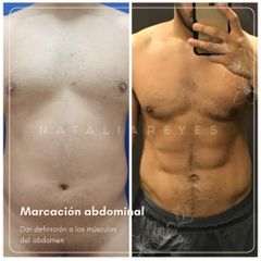 Abdominoplastia - Dra. Natalia Reyes