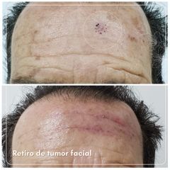 Retiro tumor facial - Dra. Natalia Reyes