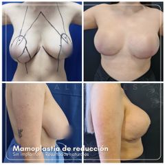 Mamoplastia de reducción - Dra. Natalia Reyes