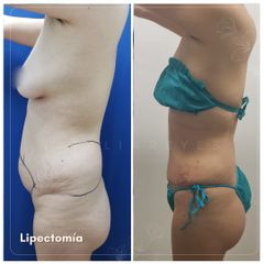 Lipectomia - Dra. Natalia Reyes