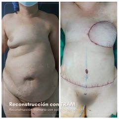 Reconstrucción de mamas - Dra. Natalia Reyes