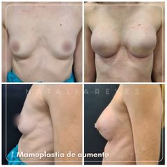 Mamoplastia de aumento - Dra. Natalia Reyes