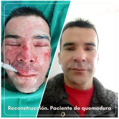 Reconstrucción quemadura - Dra. Natalia Reyes