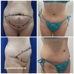 Abdominoplastia - Dra. Natalia Reyes