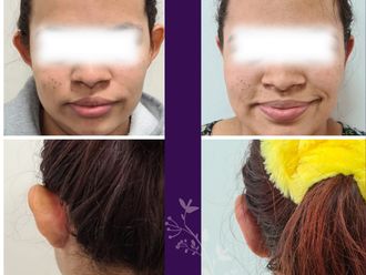 Otoplastia antes y después - 841719