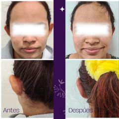 Otoplastia - Dra. Natalia Reyes