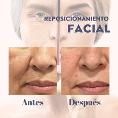 Rejuvenecimiento Facial - Dra. Natalia Reyes