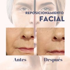 Rejuvenecimiento Facial - Dra. Natalia Reyes